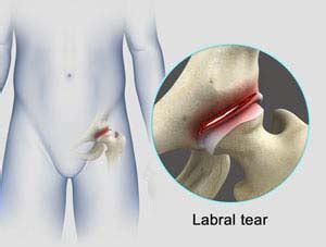 Hip Labral Repair Des Plaines Hip Labral Tear Hip Labral Injury Chicago