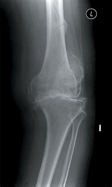 Femoral Diaphyseal Fractures Musculoskeletal Key