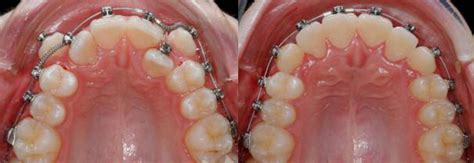 Looking for teeth fixed without braces? How to fix crooked teeth without braces and with them?