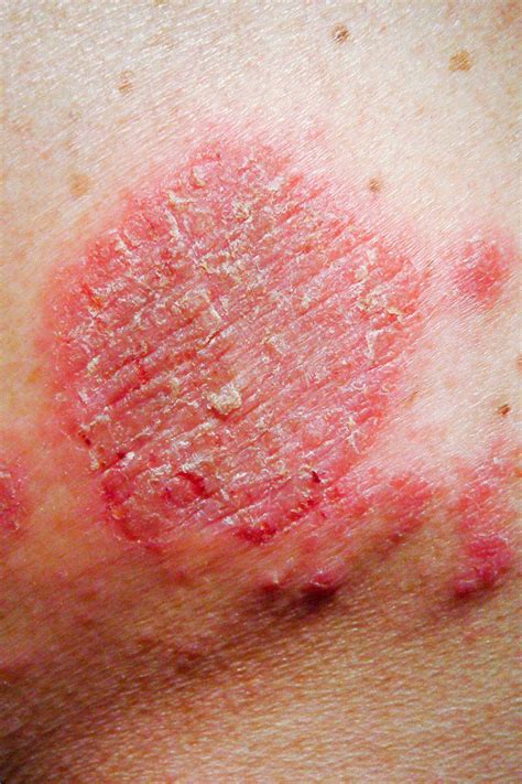 The 6 Most Common Types Of Eczema — And How To Treat Them