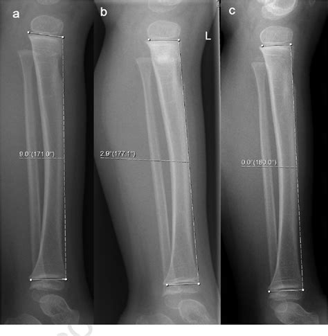 Figure 62 From The Anterior Tilt Angle Of The Proximal Tibia