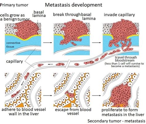 bladder cancer metastasis to brain