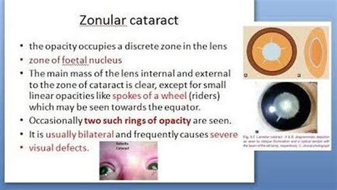 Zonular Cataract Medizzy