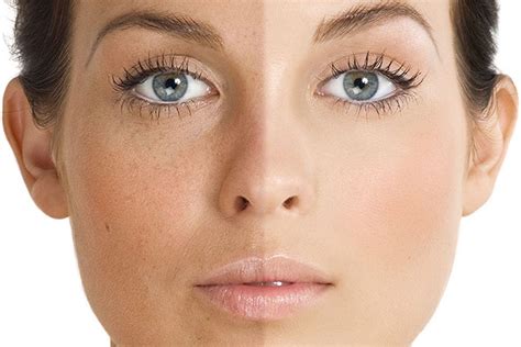 Treating Uneven Skin Tone Aesthetic And Dermatology Center