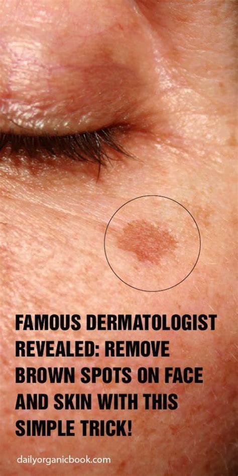 Bekannter Hautarzt Enthüllt Braune Flecken Auf Gesicht Und Haut