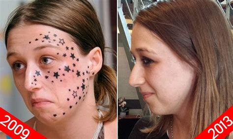 Young Belgian Woman Finally Has 56 Star Tattoos Removed From Her Face