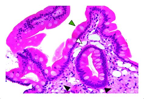 Biopsy Of The Small Intestine Showing Features Classic For Whipple S Download Scientific