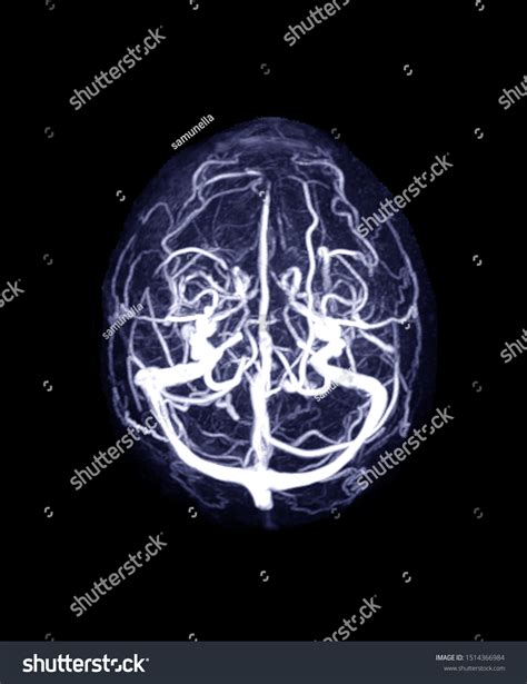Mrv Brain Magnetic Resonance Venography Brain Stock Photo 1514366984