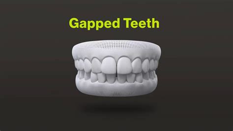 Gapped Teeth Youtube