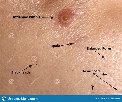 Types Of Acne And Acne On The Skin Enlarged Pores Inflamed Pimple