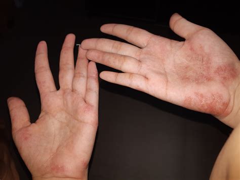 Hand Dermatitis