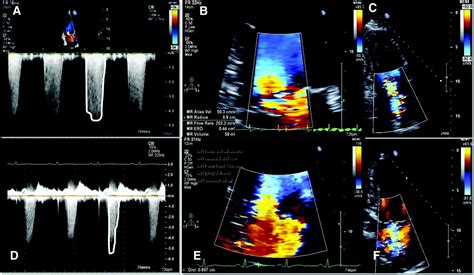 Mitral Valve Prolapse With Regurgitation