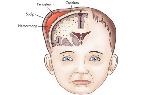 Cefalohematoma Neonatal
