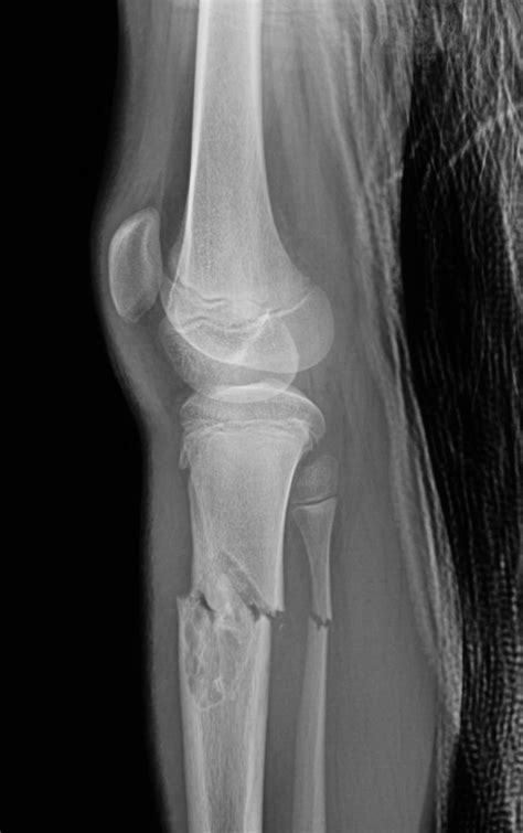 Cureus Non Ossifying Fibroma Pathological Fracture In A Patient With