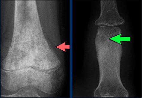 The Radiology Assistant Bone Tumors Differential Diagnosis