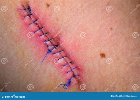 Stitched Up Wound After Mole Removal Surgery Stock Photo Image Of