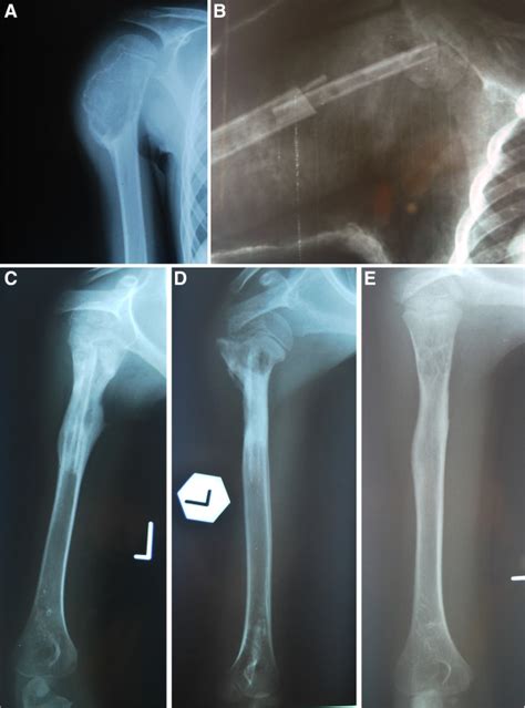 Example Of A Patient With An Aneurysmal Bone Cyst Abc In The Humerus