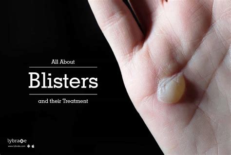 All About Blisters And Their Treatment By Dr Umesh Alegaonkar Lybrate