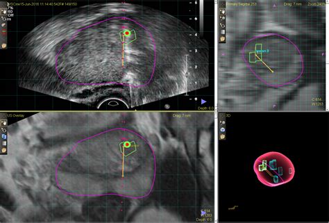 Mrultrasound Fusion Guided Biopsy Of The Prostate A Better Way To Biopsy The Prostate Ck Ng
