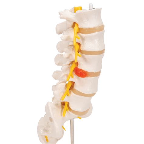 Human Anatomy Skeleton Spine Lumbar Disc Herniation Teaching Model My