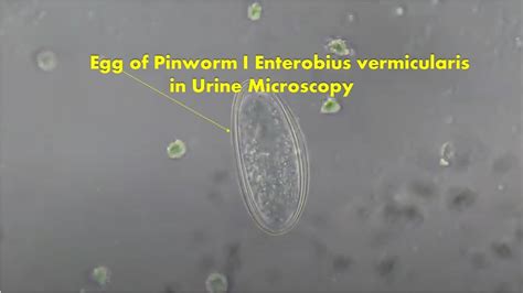 Egg Of Pinworm In Urine Microscopy Enterobius Vermicularis YouTube