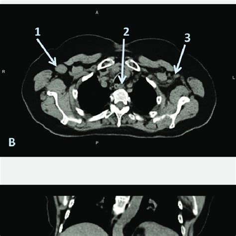 Pet Ct Images Showing Diffuse Lymphadenopathy In Axillary Regions