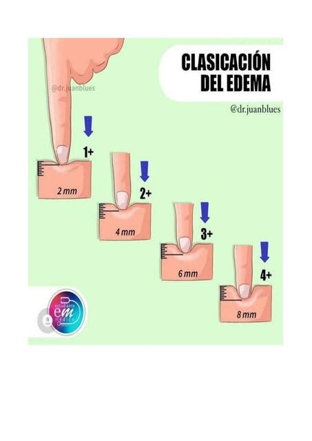 Clasificación Del Edema Altagracia Medina Valdez Udocz