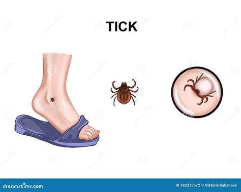 Encephalitis Tick Bite Stock Illustration Illustration Of Infestation