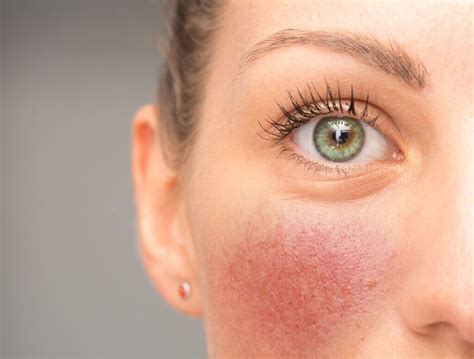 Rosacea 101 What You Need To Know Us Dermatology Partners