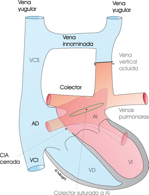 Drenaje venoso pulmonar anómalo total DVPAT