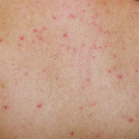Coeliac Disease Skin Rash Help With Skin Rash Dermatitis