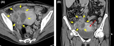 cornual abscess rupture a rare etiology of acute abdomen patil 2018 clinical case reports