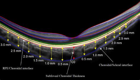 Choroidal Thickness Measurements On Optovue Rtvue Oct Enhance Line