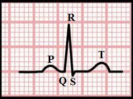 Kalau kemiringannya 0 akibatnya dihasilkan defleksi ke bawah (gelombang q tanpa r). Cara Mudah Membaca Gelombang EKG - Jantung Area