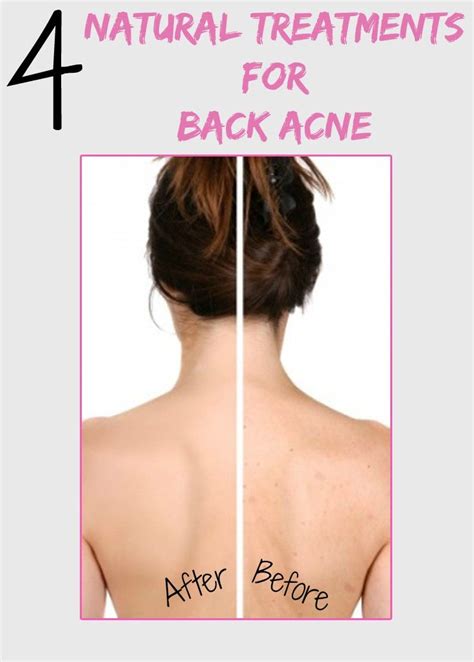 Womens Mag Blog 4 Natural Treatments For Back Acne Best Acne