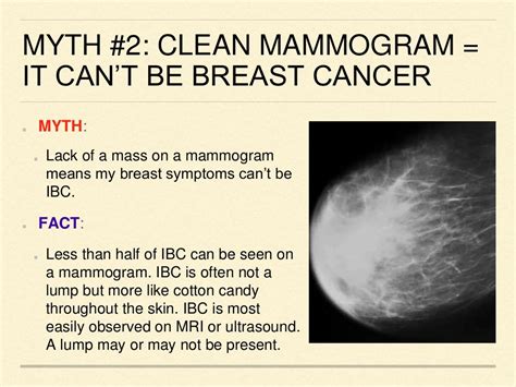 Top 10 Inflammatory Breast Cancer Ibc Myths