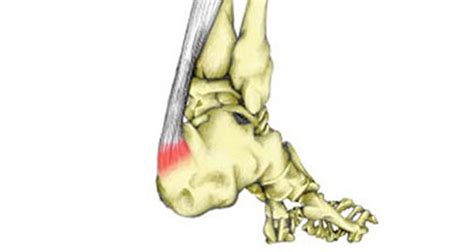 Insertional Achilles Tendonitis Symptoms Causes Treatment And Rehab