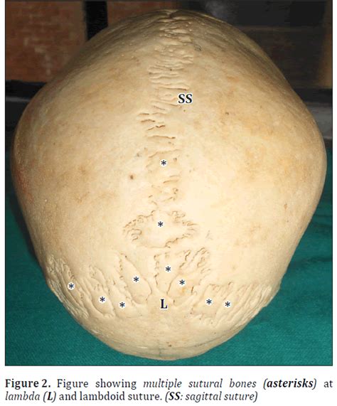 Human Skull With Complete Metopic Suture And Multiple Sutural Bones At