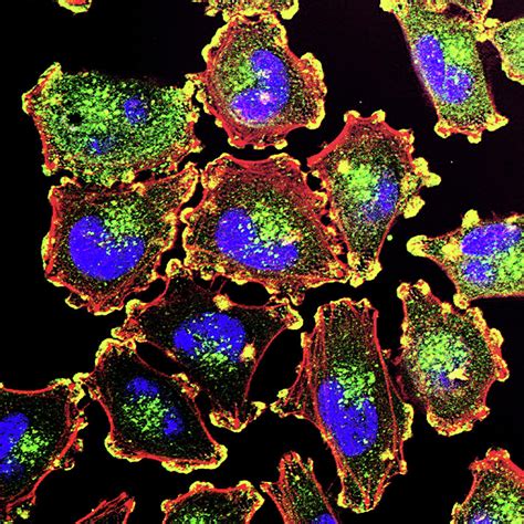 Metastatic Melanoma Cells Photograph By Nci Center For Cancer Research