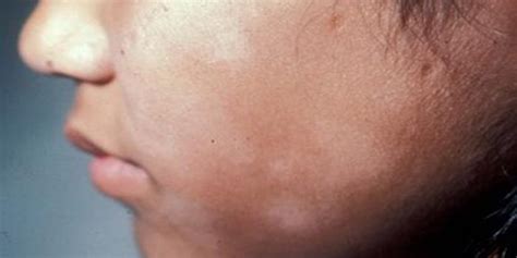 Prevención Y Tratamiento De Las Manchas Blancas De La Cara