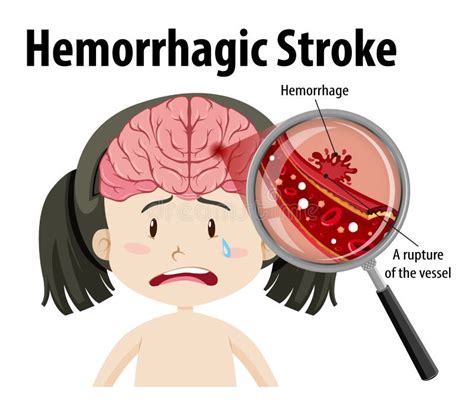 Girl With Hemorrhagic Stroke Stock Vector Illustration Of Diagram Medical 250878232