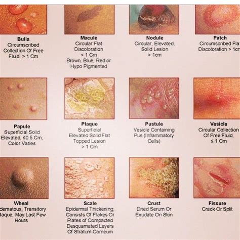 Medical Doctor On Instagram Different Skin Rashes Rash Skin Scale Pustule Bulla