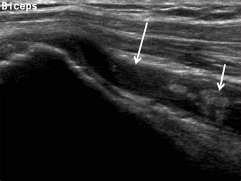 Biceps Brachii Tendon Tear Longitudinal Scan Of The Bi Open I