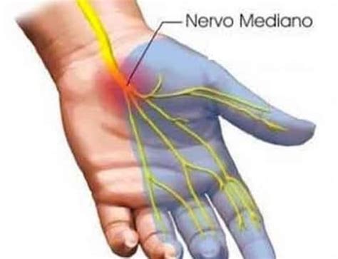 Sindrome Del Tunnel Carpale Cos Sintomi Diagnosi E Trattamento