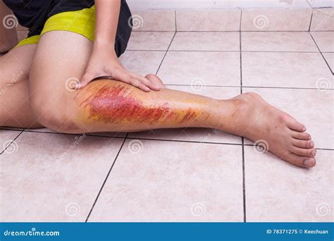 Hand Embracing Injured Knee With Painful Abrasion From Fall Stock Image