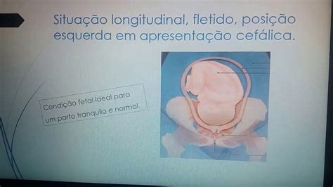 Estática Fetal posições do feto na pelve materna estáticafetal