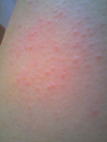 De l'ail alors si vous avez des petits boutons qui piquent dans le cou, il faut à tout prix éviter de vous gratter. Petits boutons sur jambes - Allergies et eczéma - FORUM Santé
