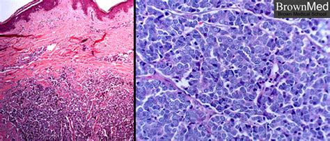 Merkel Cell Histology Histopathology Images Of Small Cell Carcinoma
