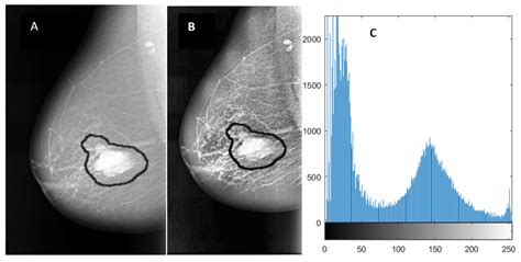 Breast Cancer Detection Using Deep Convolutional Neural Networks And