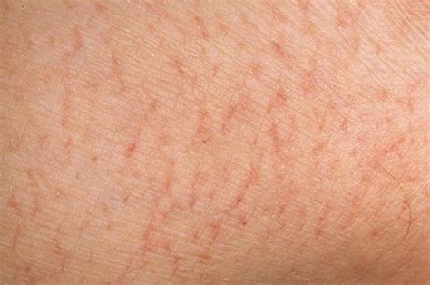 Eczema Skin Diseases Photos Dry Skin Eczema Pictures №35 Say No To